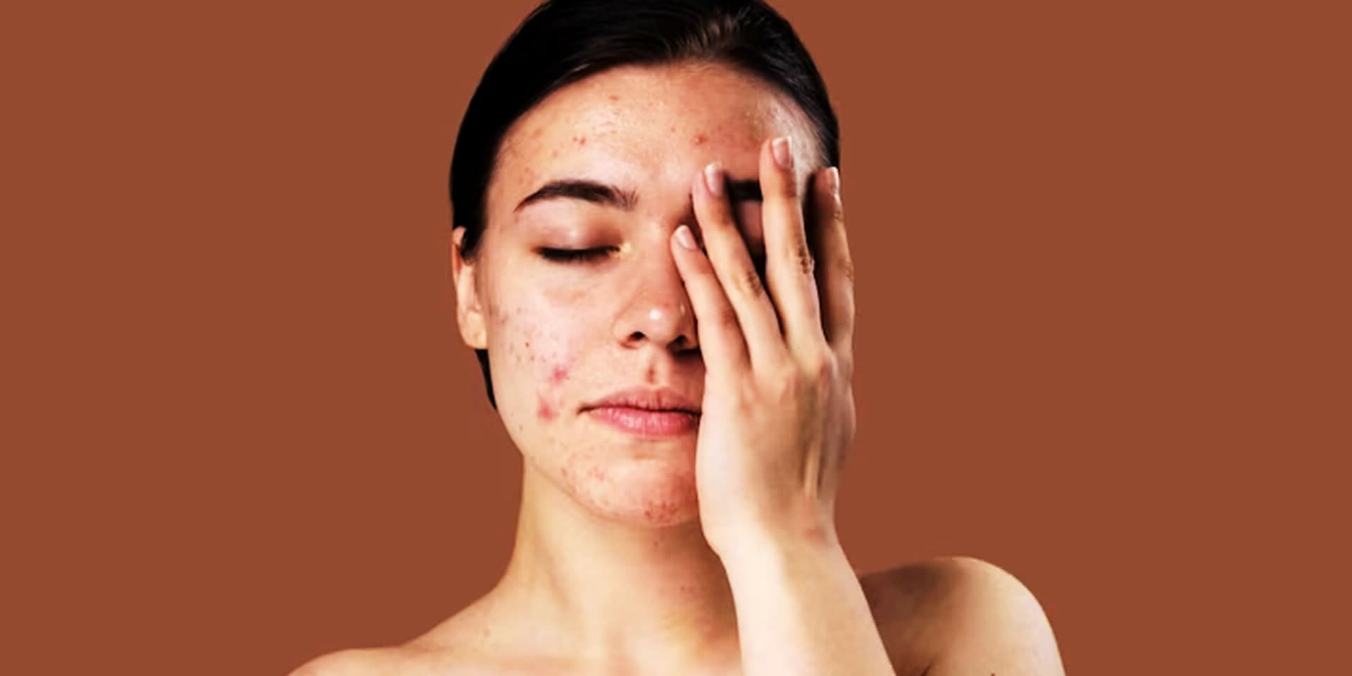 Essential Tips for Preventing Summer Acne: What You Need to Know